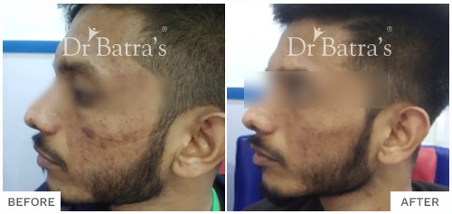 Before After Image of Sagar Kale for Acne Treatment