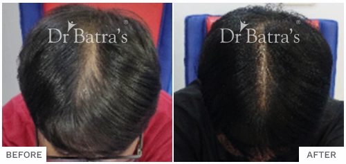 Before After Image of Saurabh Jaiswal for AGA Male + DDF Treatment