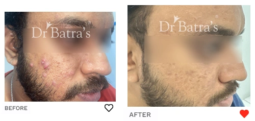 Before After Image of Shubham Dey for Acne Treatment