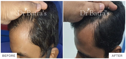 Before After Image of Shyama Maharana for AGA Male Treatment