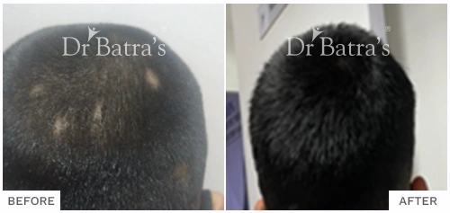 Before After Image of Ujjawal Kumar for Patchy Hair Loss, Alopecia Areata Treatment