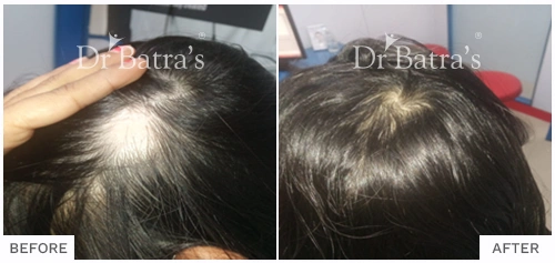 Before After Image of Vinanti Mahajan for Patchy Hair Loss Treatment