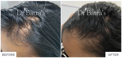 Before After Image of Yashika for Telogen EffluviumTreatment