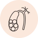 Excess cholesterol in bile