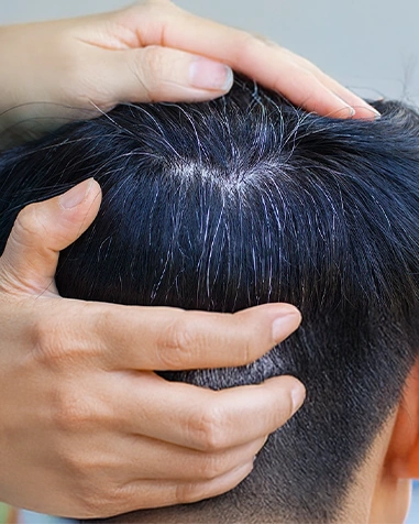Hair Loss