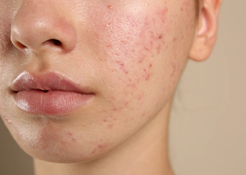 Acne and oily skin
