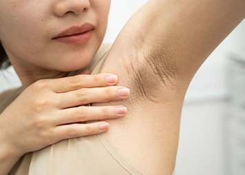 Dark skin patches