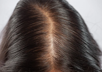 Hair thinning