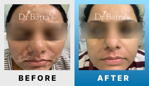 02 Vitiligo Before After