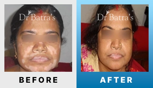 06 Vitiligo Before After